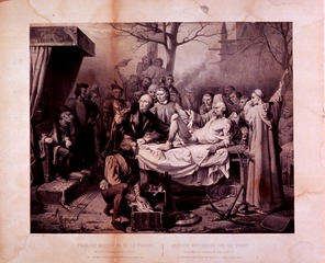 Earliest operation for the stone