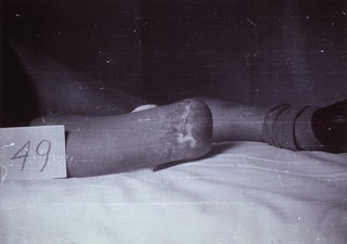 [Artificial limbs]: [Amputee]