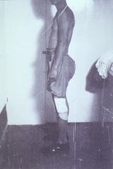[Artificial limbs]: [Amputee with prosthesis, Philipines, 1940s(?)]