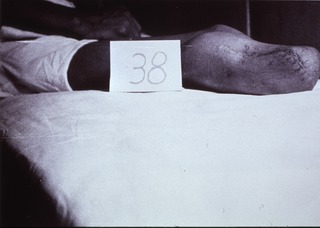 [Artificial limbs]: [Amputee, Philipines, 1940s(?)]