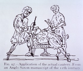 Application of the actual cautery