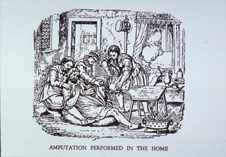 [Amputation performed in the home]