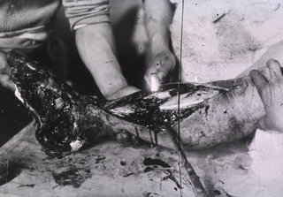 [View of severely wounded leg on operating table]