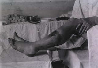 [View of wounded leg on operating table]