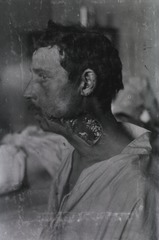 [View of open wound on soldier's neck and face]