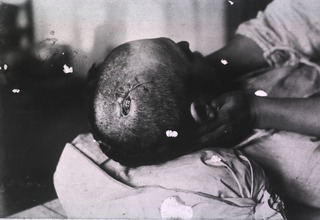 [View of open wound on top of soldier's head]