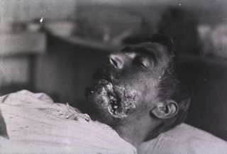 [View of open wound on soldier's face]