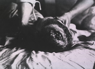 [View of open wound on soldier's head]