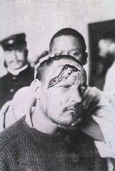 [View of open wound on soldier's head and face]