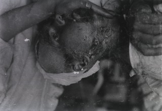 [View of open wounds on soldier's head and face]