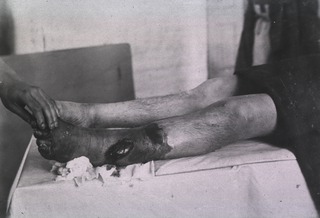 [View of wounded gangrenous leg]