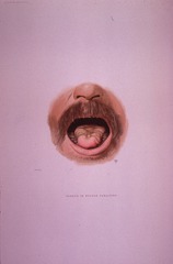 Tongue in Chronic Progressive Bulbar Paralysis