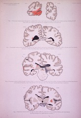 A Series of Transverse Vertical Sections Through the Brain in a Case of Lesion of the Half-Vision Centre