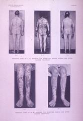 Psoriasis Treated by Thyroid Feeding