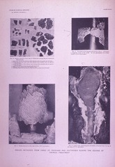 Scales Detached From Cases of Psoriasis and Ichthyosis During the Course of Thyroid Treatment