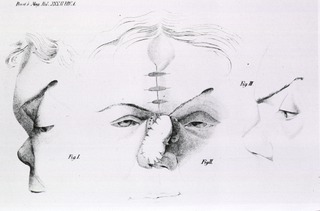[Plastic Surgery and the effects of Lupus: Dr. Keith's case of restoration of lost nose]