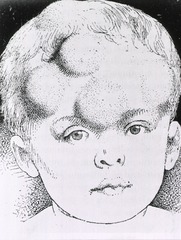 [Venereal diseases: Young child with the gummata (cranial) of hereditary syphilis]