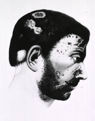 [Venereal diseases: Syphilitic ulcers and pustules on the head]