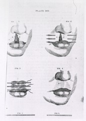 [Procedure for treating cleft lip]