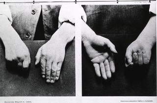 [Paralysis agitans]: [Hands of Parkinson's victim]