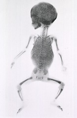 [Embryology - X-Rays: Foetus at five months]