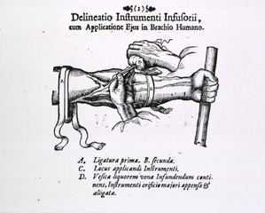 [Infusion apparatus used on arm]