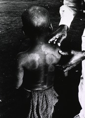 [Skin lesions on a young leprosy patient]