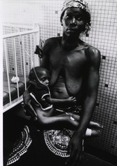 In the Ouagadougou Hospital rehydration fluids are administered to a child with marasmus, whoose mother has another deificiency disease, goitre