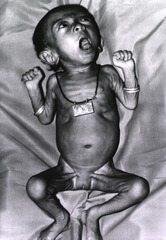 When coupled with malnutrition, as in this Indonesian child, whooping cough is still one of the killer diseases