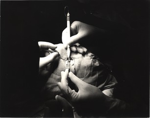 The surgical instrument used here for a cataract operation ... is known as a cryoprobe