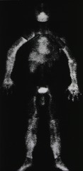This photos, or rather composite of a series of photographs, shows isotopes revealing the inner geography of the body. Isotopes reorded in photographic form cna show where vitamins or medicines are distributed, or in come cases where blockage occurs. These photographs were taken by a scintillation camera
