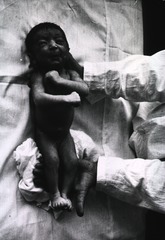 Tetanus in the new-born child. Immunizing pregant women, proper care at birth, and clean handling of the umbilical cord can prevent such cases