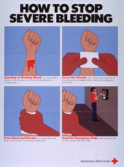 How to stop severe bleeding