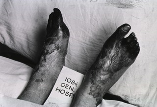 [Photograph of two cadaverous feet, 108th General Hospital, France]