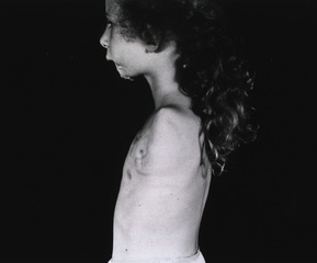 [Left side profile of a young girl with her arm amputated at the shoulder]