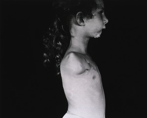 [Right side profile of a young girl with her arm amputated at the shoulder]