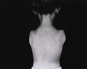 [Back side view of a young girl with her arms amputated at the shoulders]