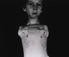[Full face view of a young girl with both arms amputated at the shoulders]