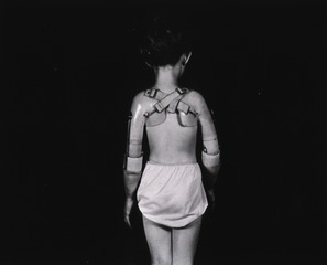 [Back side view of a young girl fitted with prosthetic arms]