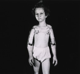 [Full face view of a young girl fitted with prosthetic arms]