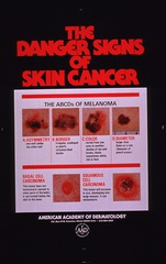 The danger signs of skin cancer