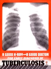 A good x-ray and a good doctor: for an early diagnosis of tuberculosis