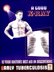 A good X-ray is your doctor's best aid in discovering early tuberculosis