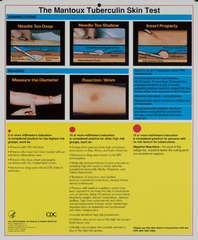 The Mantoux tuberculin skin test