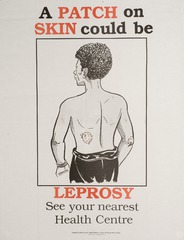 A patch on skin could be leprosy