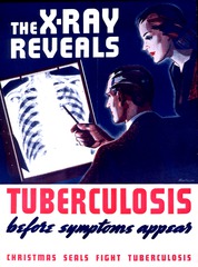 The x-ray reveals tuberculosis before symptoms appear