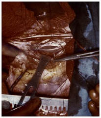 First picture of the inside of the heart in open operation