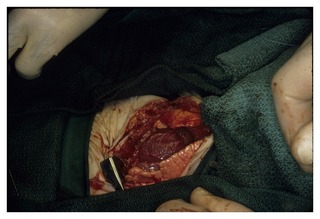 Open chest during transplantation surgery