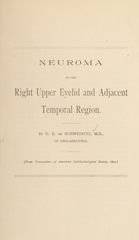 Neuroma of the right upper eyelid and adjacent temporal region